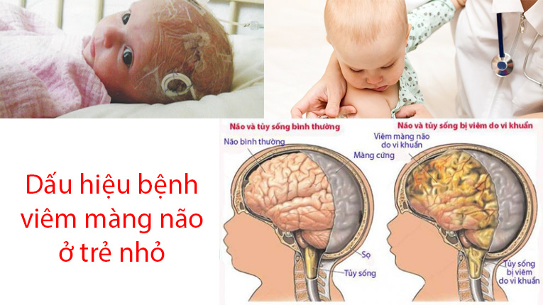 Dấu Hiệu Viêm Màng Não Ở Trẻ Sơ Sinh