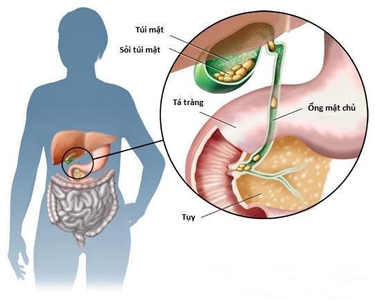 6. Ngăn Ngừa Tái Phát Sỏi Mật