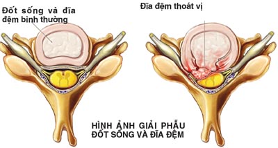 cach-don-gian-phong-thoat-vi-dia-dem.jpg