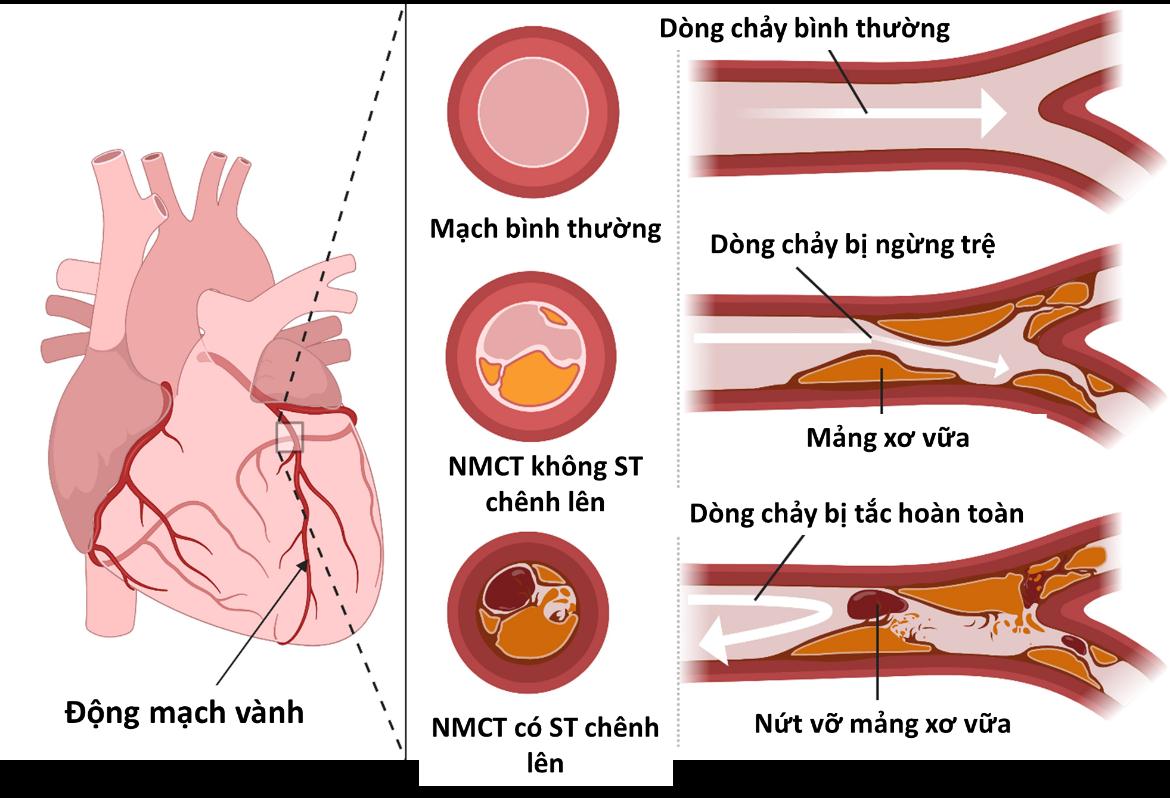 Nhồi Máu Cơ Tim Không ST Chênh Lên: Triệu Chứng, Nguyên Nhân Và Cách Điều Trị Hiệu Quả