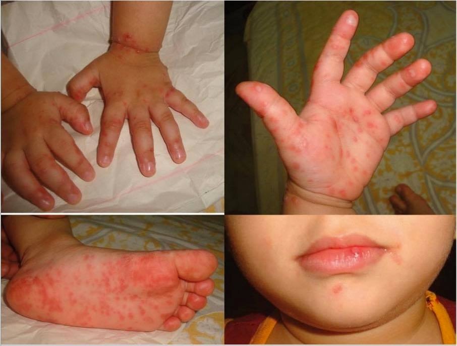 Các triệu chứng bệnh tay chân miệng ở trẻ em